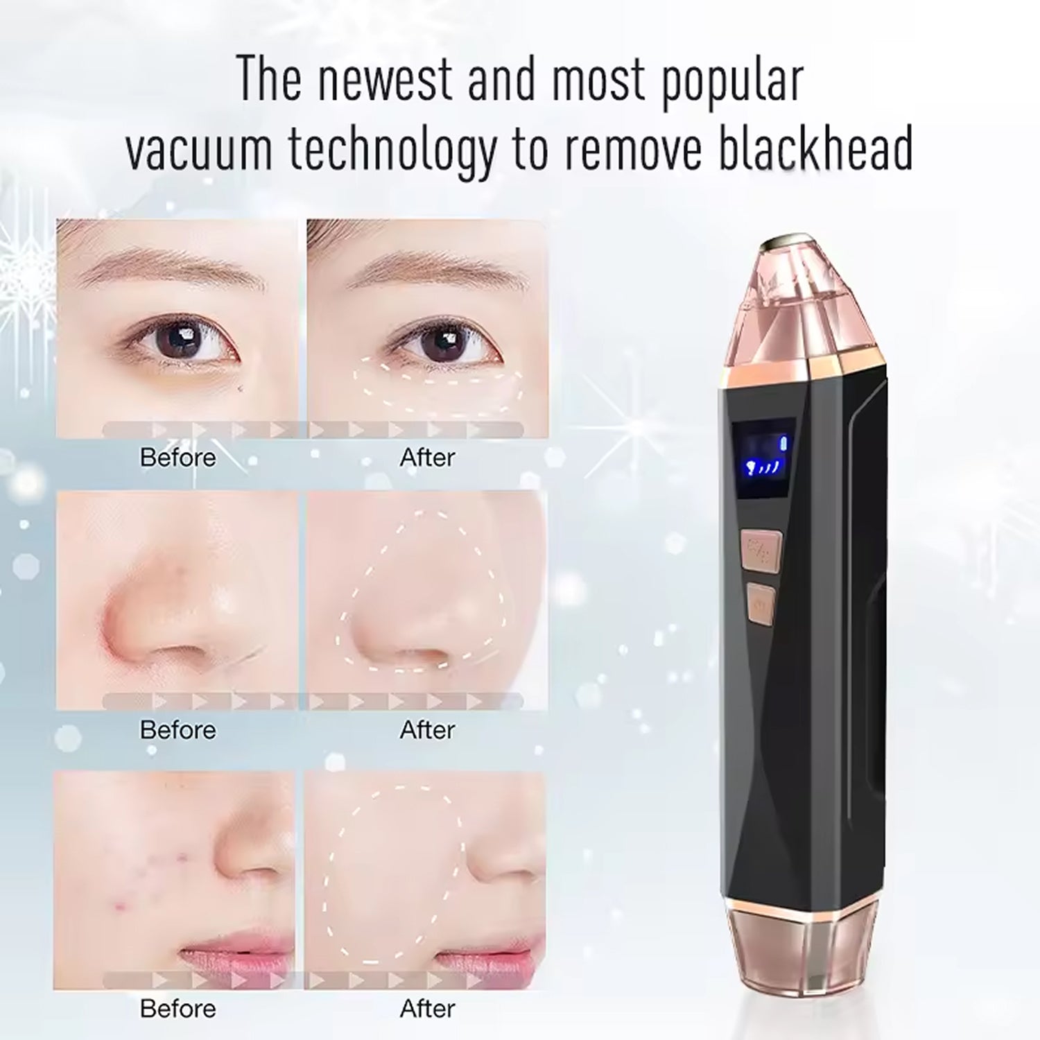 ZynVac Pore Vacuum